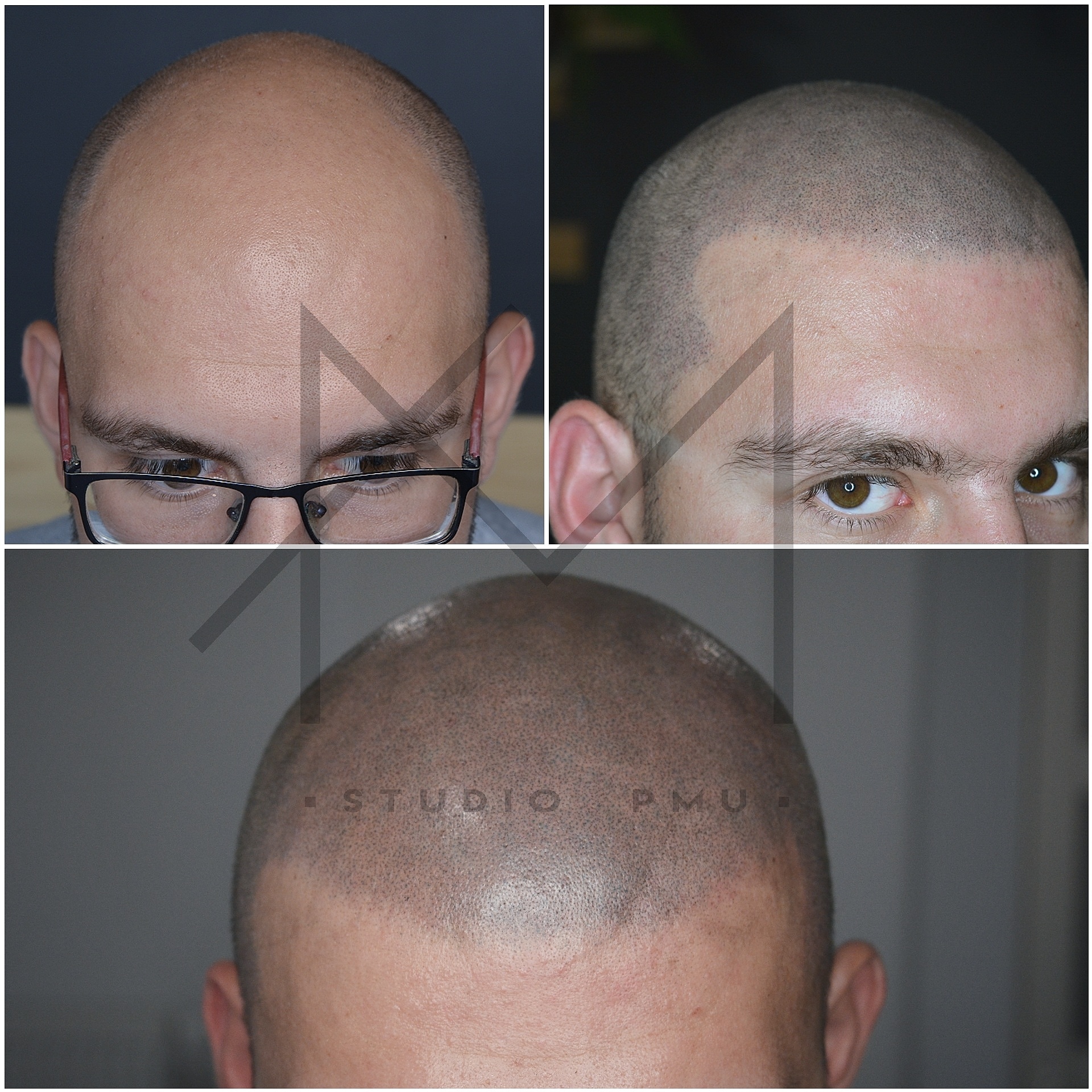 Mikropigmentacja Skóry Głowy Mikropigmentacja Medyczna Włosów Łódź Mikropigmentacja Głowy