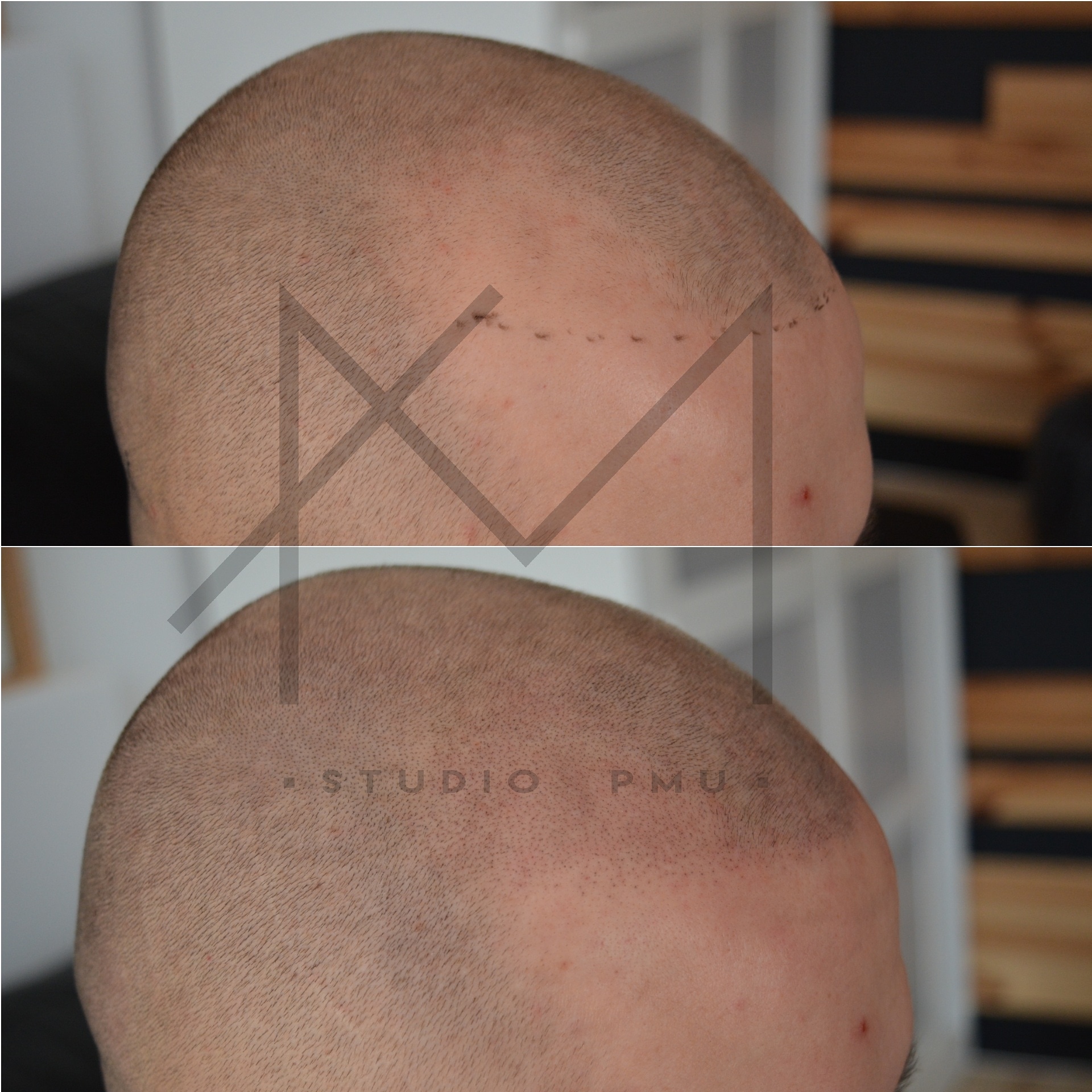 Mikropigmentacja Skóry Głowy Mikropigmentacja Medyczna Włosów Łódź Mikropigmentacja Głowy amstudiopmu