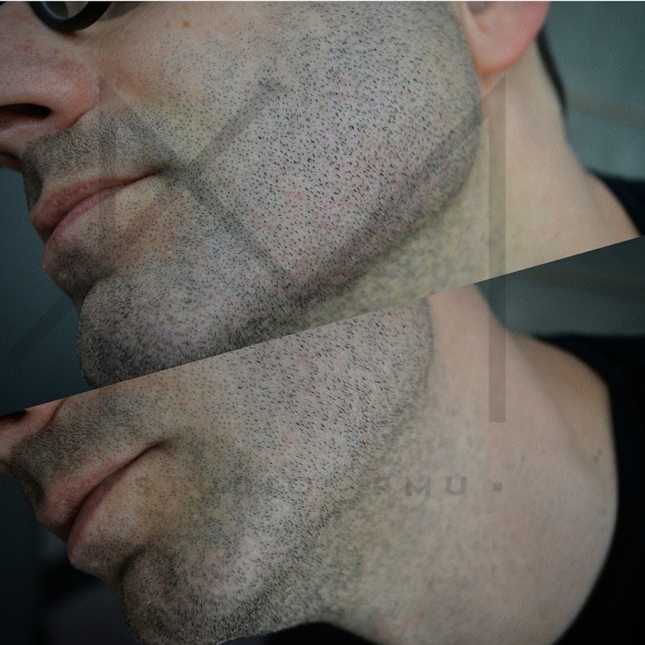 mikropigmentacja zarostu brody zagęszczanie