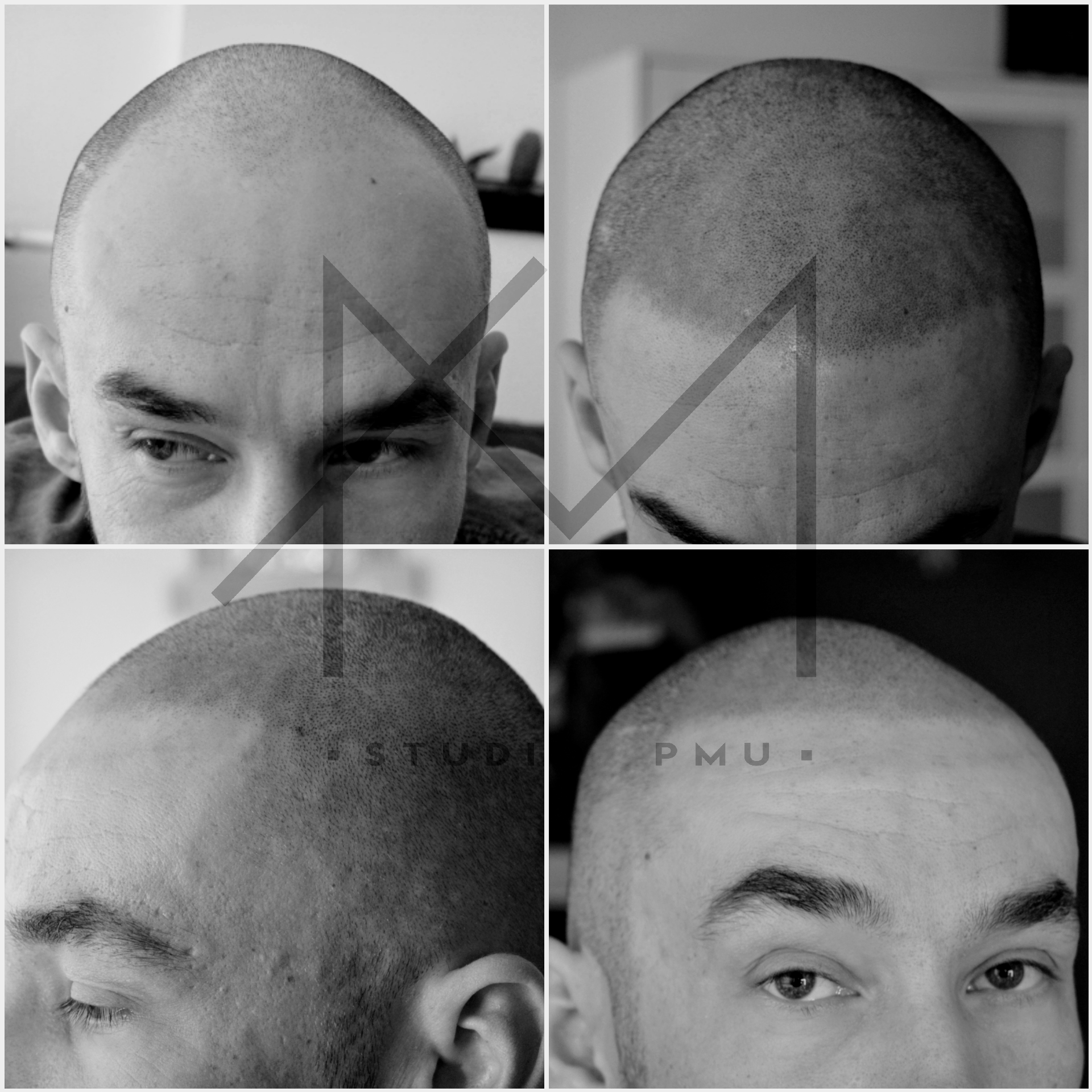 Mikropigmentacja Skóry Głowy Mikropigmentacja Medyczna Włosów Łódź Mikropigmentacja Głowy q