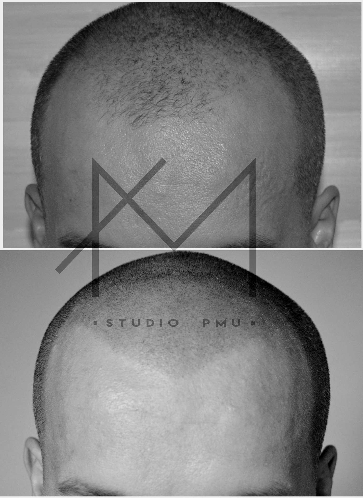 głowa męska po zabiegu mikropigmentacji