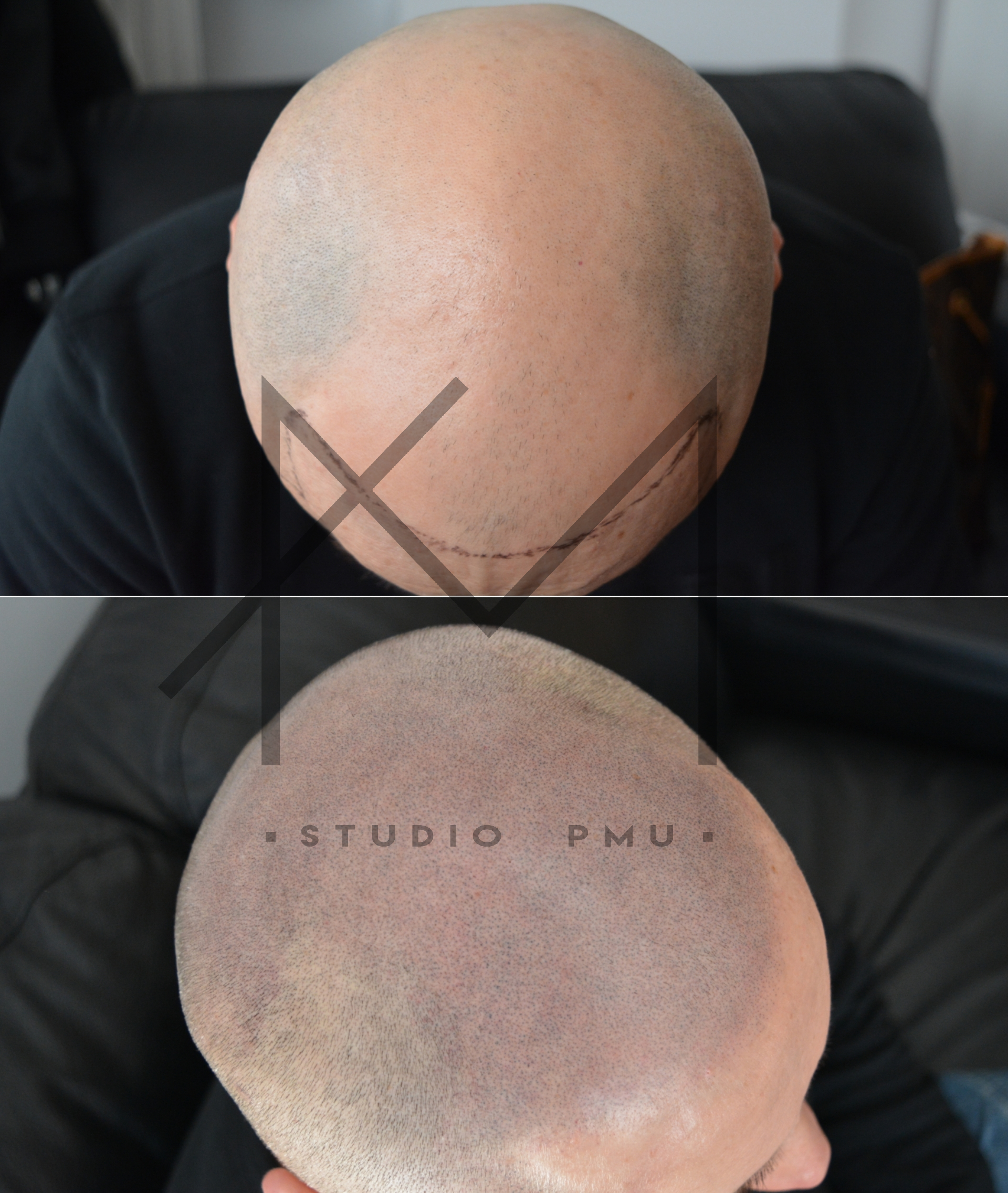 głowa męska po zabiegu mikropigmentacji skóry
