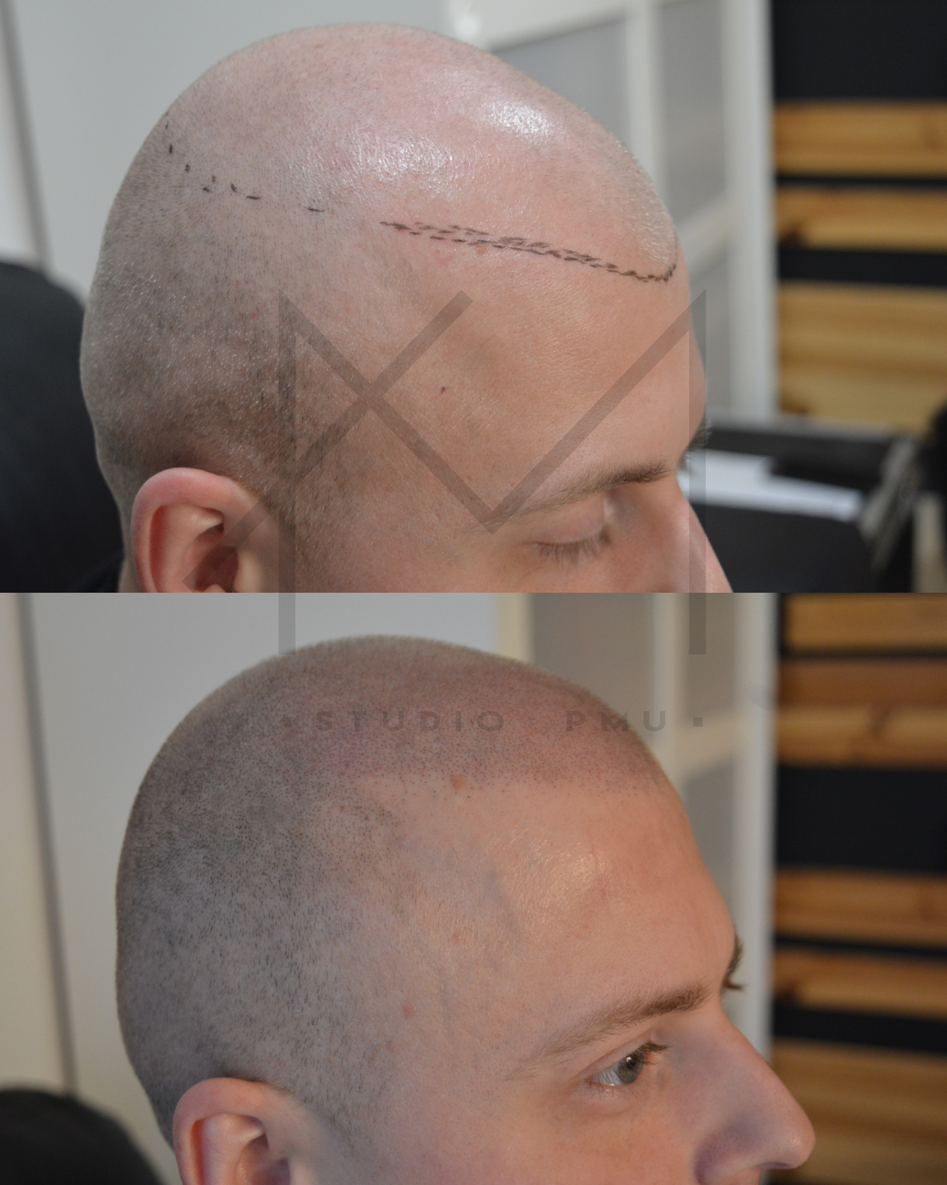 sposób na łysiejące zakola siwiejące włosy Mikropigmentacja głowy z pomocą AMStudioPMU Łódź