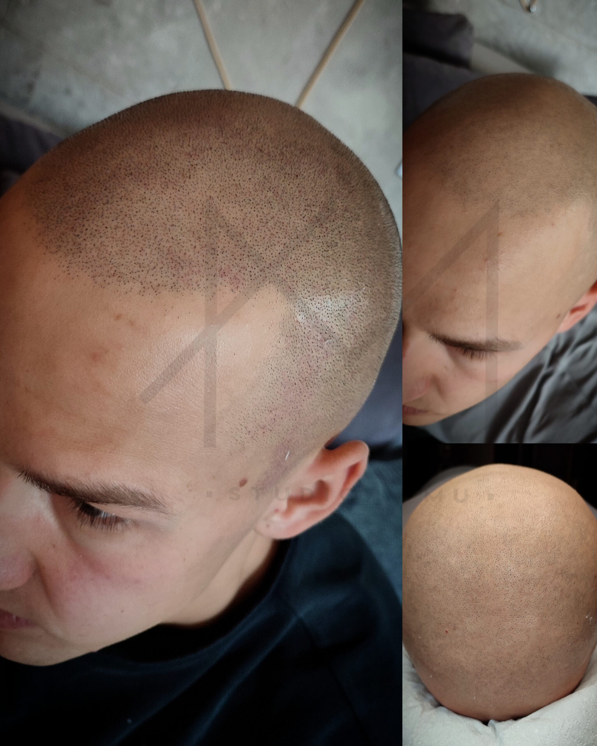jak zagęścić włosy mikropigmentacja głowy AMStudioPMU Łódź