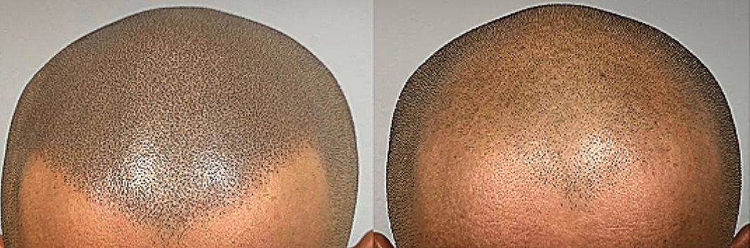 Dwie sesje zagęszczania wypadających włosów wystarczyły, aby nadać zdrowy wygląd. Nie zwlekaj z zabiegiem mikropigmentacji